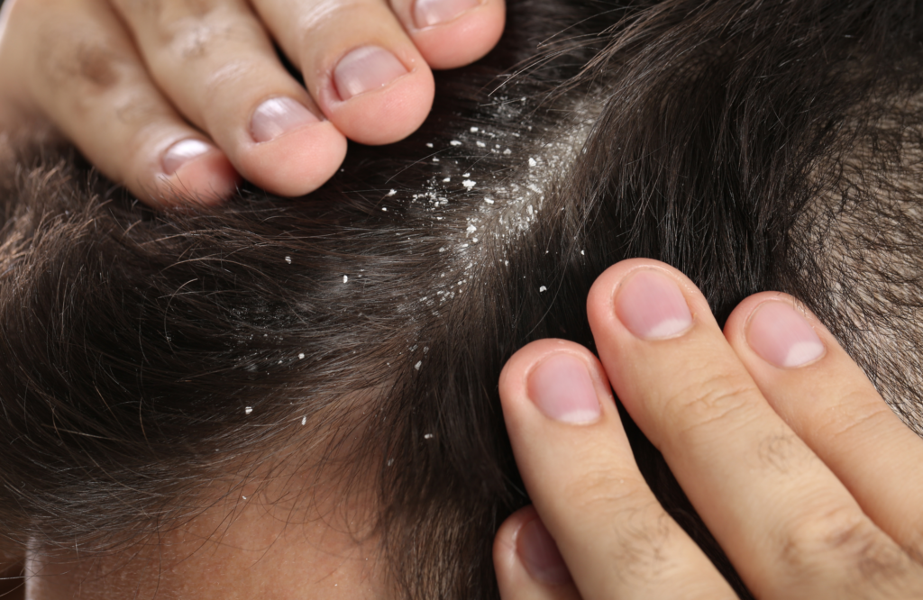 Mujer mostrando su Cabello con caspa. Falta de uso del Agua de Manzanilla para el pelo