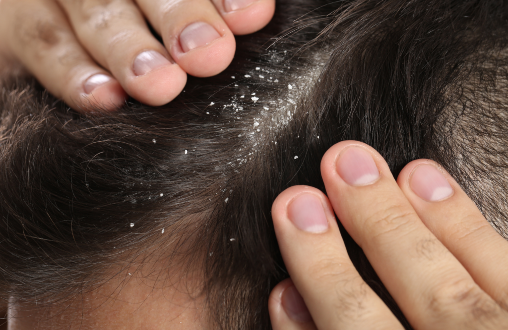 Mujer mostrando su cabello con caspa